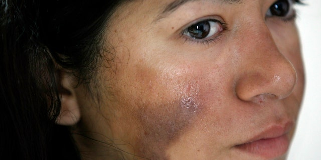 Indian climber Ameesha Chauhan who survived dangerous overcrowding on Mount Everest gets treatment at a hospital after she was rescued in Kathmandu, Nepal.