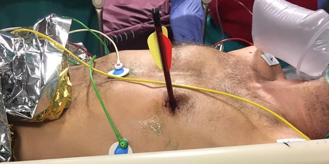 A man in Italy arrived at Molinette Hospital in Turin on May 21 with an arrow sticking out of his chest, reports say.