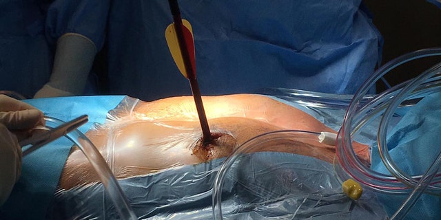 Officials said that the procedure was an “exceptional” success.