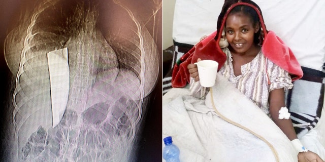 Kume Bayisa was reportedly released from the hospital in March, three months after her emergency surgery.