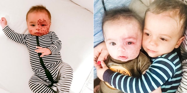 Leo, pictured left after a laser treatment and right with his older brother Leo, was diagnosed with Sturge-Weber Syndrome (SWS) after the doctors noticed a large birthmark covering half of his face to His birth.