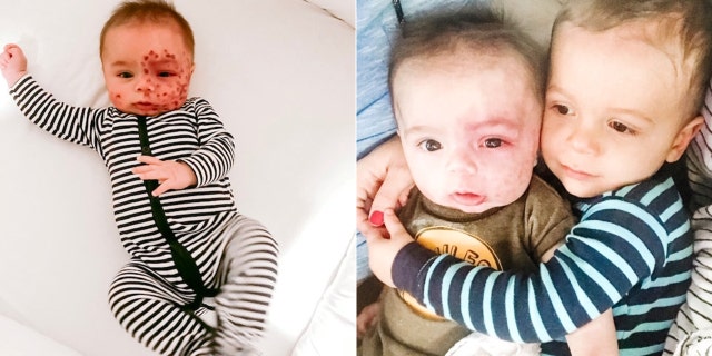 Leo, pictured left after a laser treatment and right with his older brother Leo, was diagnosed with Sturge-Weber Syndrome (SWS) after doctors noticed a large birthmark covering half of his face when he was born.