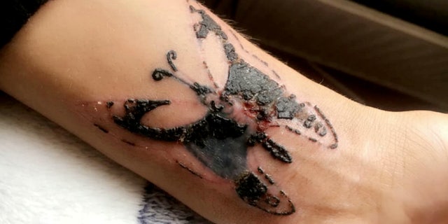 Woman Claims Botched At Home Tattoo Landed Her In Hospital Fox News Woman Claims Botched At Home Tattoo Landed Her In Hospital Fox News