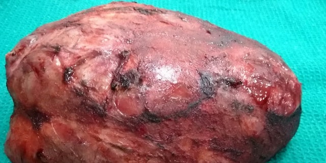 The tumor weighed 11 pounds and took 10 hours to remove. 