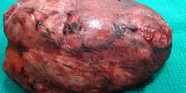 The tumor weighed 11 pounds and took 10 hours to remove.