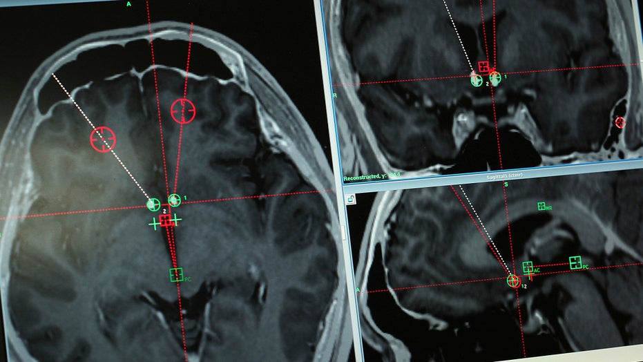 Overlooked Brain Cells May Have Leading >> Doctors Eye Deep Brain Stimulation To Treat Opioid Addiction Fox News Overlooked Brain Cells May Have Leading >> Doctors Eye Deep Brain Stimulation To Treat Opioid Addiction Fox News