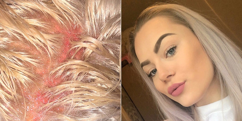 Woman Claims She Was Left With Oozing Blisters After Getting Hair