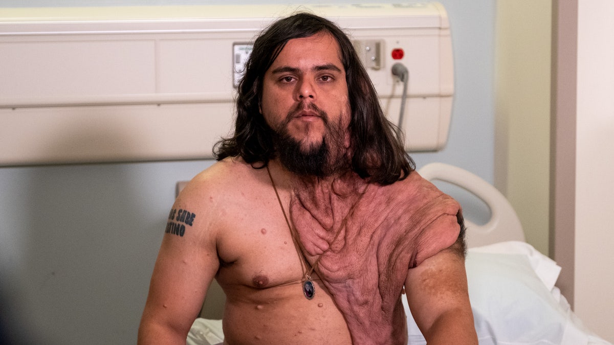Galvan, pictured before his surgery, started developing symptoms when he was just 5, which led to a childhood marred by bullying.