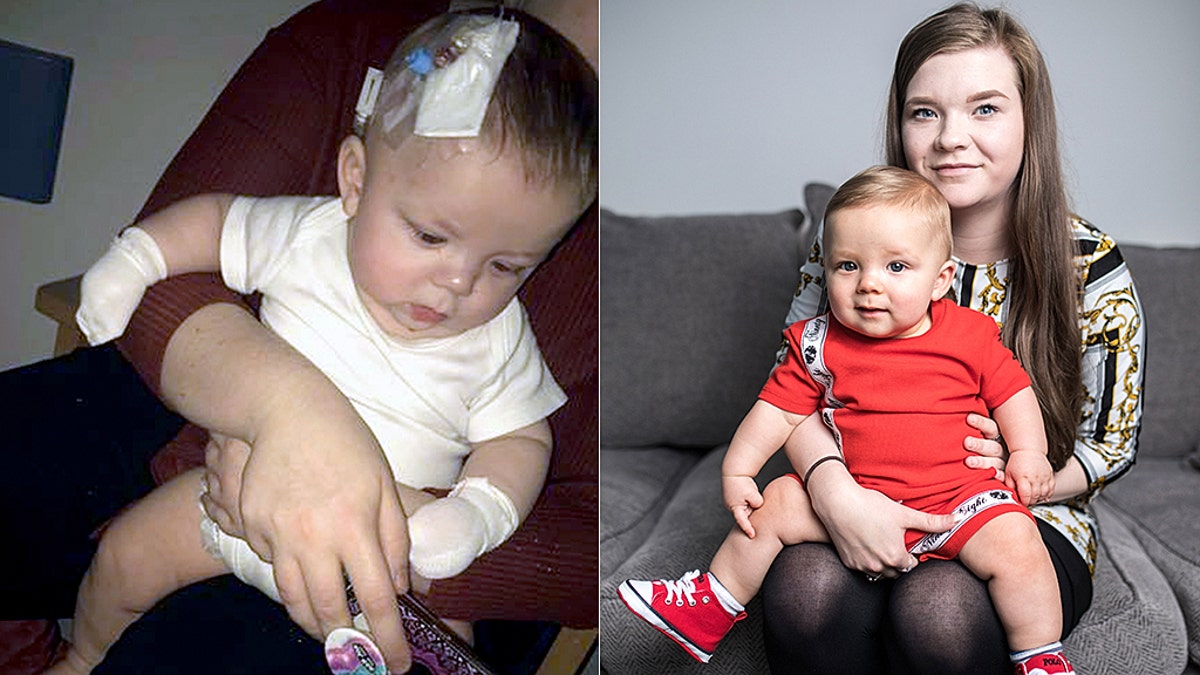 Noah, pictured during his recurrence in March, and right healthy, allegedly contracted the virus from an infected person at a christening.