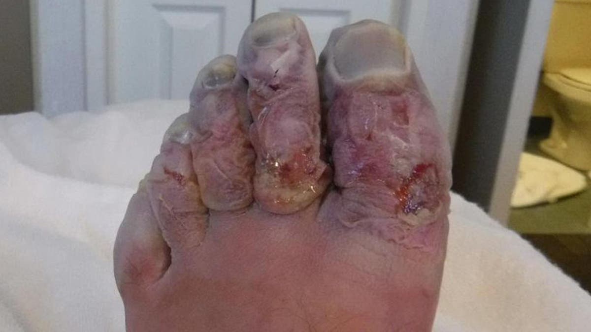 Griffith's toes were removed upon further treatment in England.