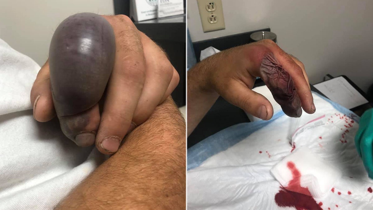 Tennessee man's finger balloons, pops, sheds skin in gory pics