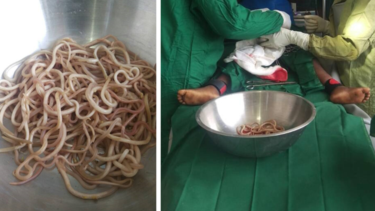 GRAPHIC IMAGES: Boy, 4, has dozens of worms removed from intestines after  complaints of pain, vomiting