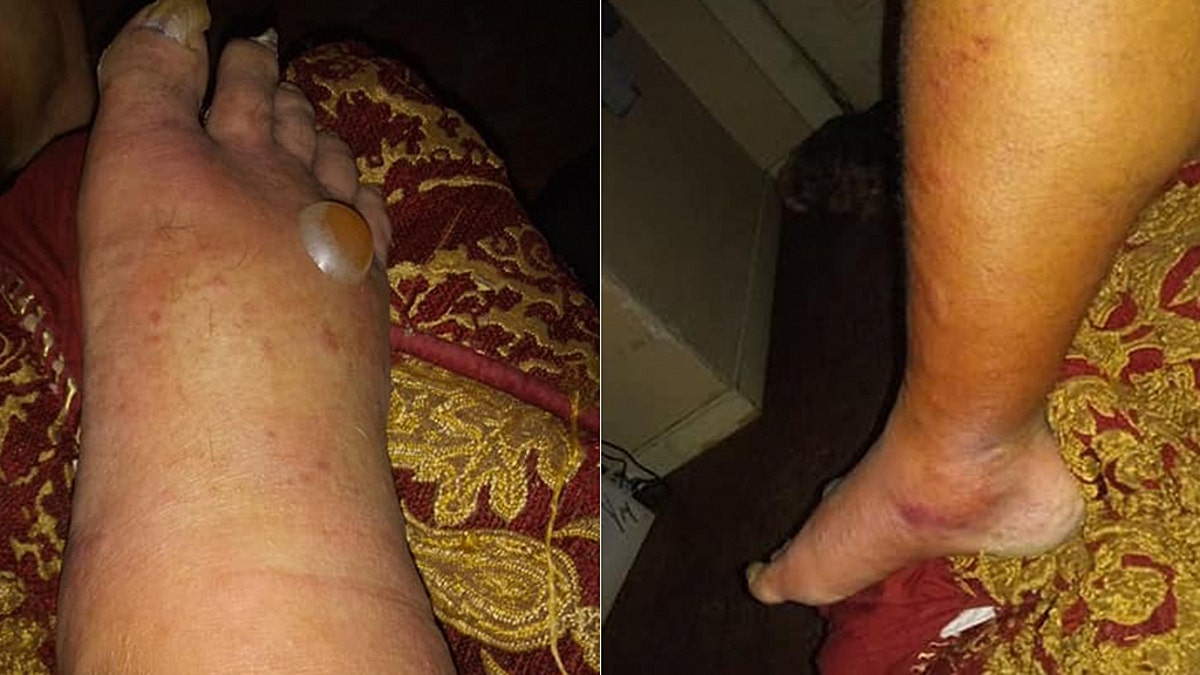 He's undergone at least four surgeries to remove affected tissue.