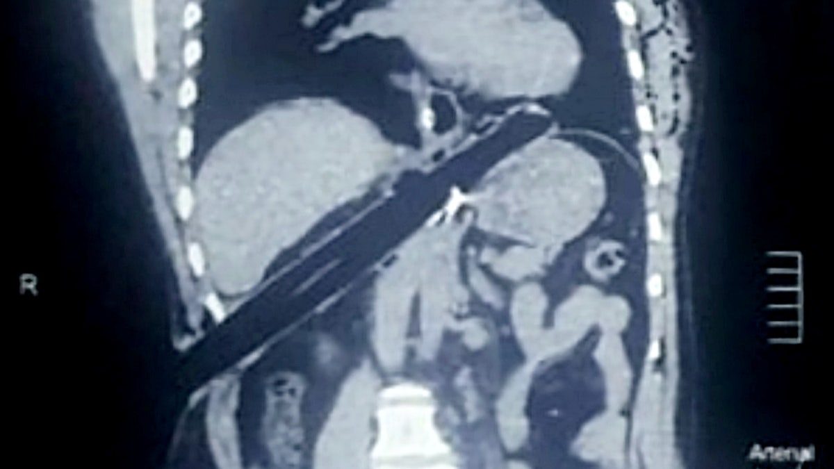 An X-ray shows the bamboo's trajectory after it pierced his skin and traveled upward through his chest.