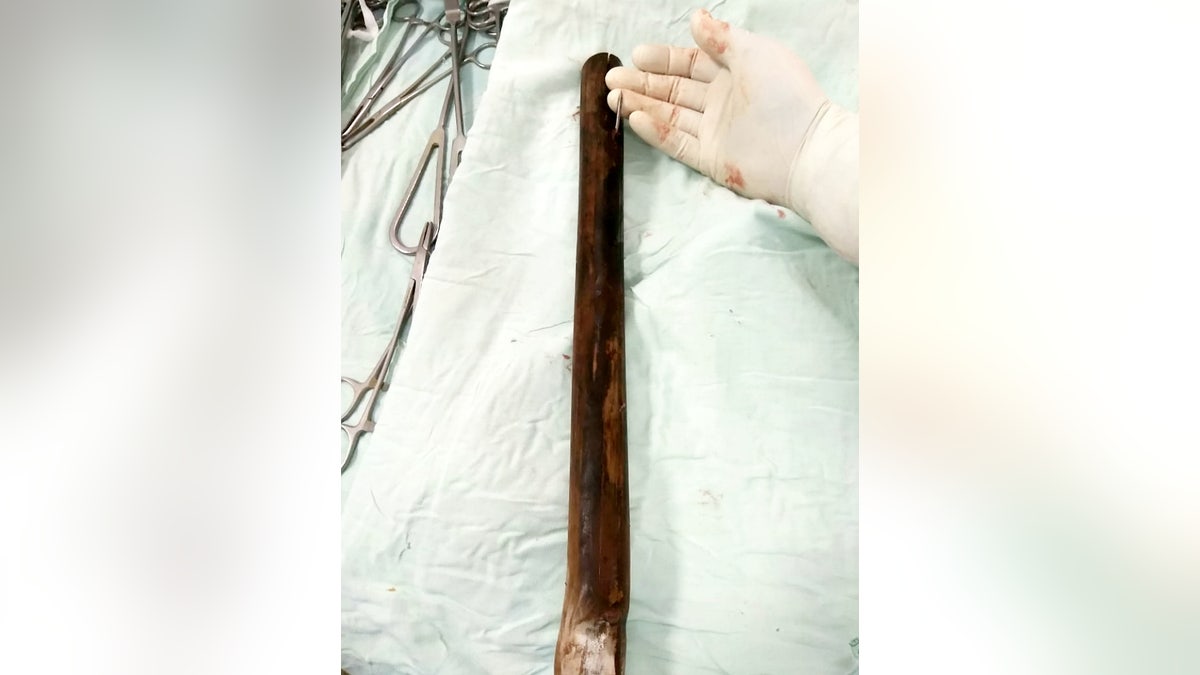 It took surgeons several hours to remove the bamboo spike, which was just inches from his heart.