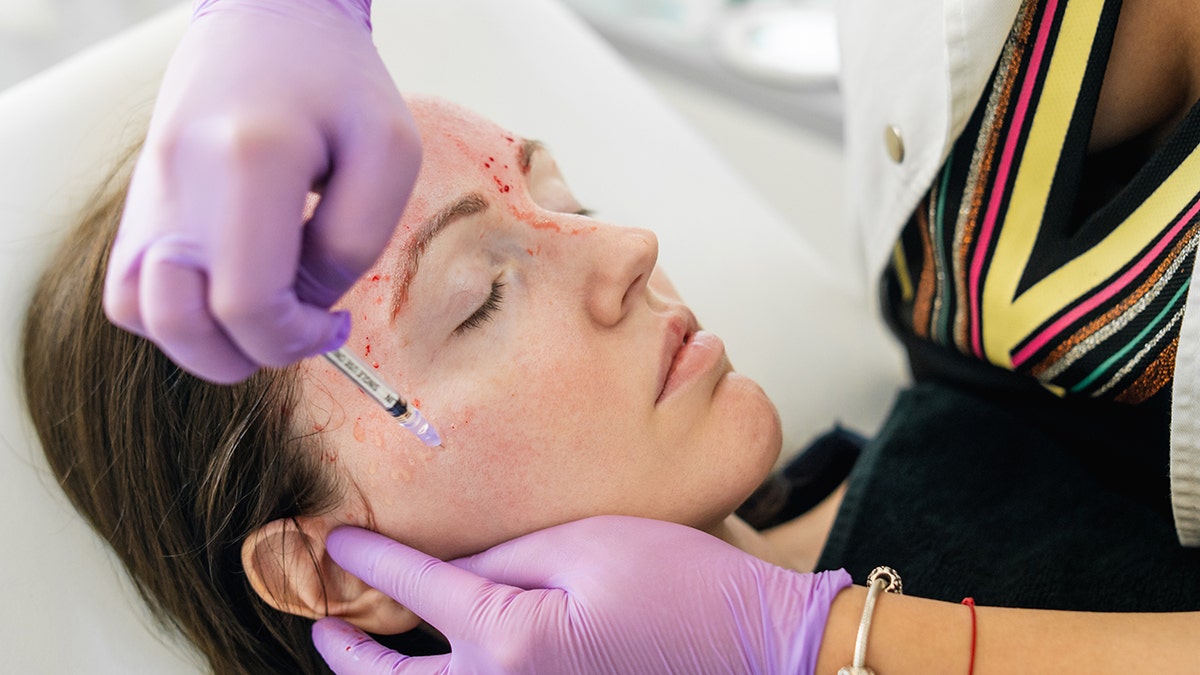 Vampire facials, officially known as Platelet Rich Plasma (PRP) therapies, involves extracting platelets from a client’s blood and injected those platelets back into the patient’s face through micro-needling for what some believe to be rejuvenative purposes.