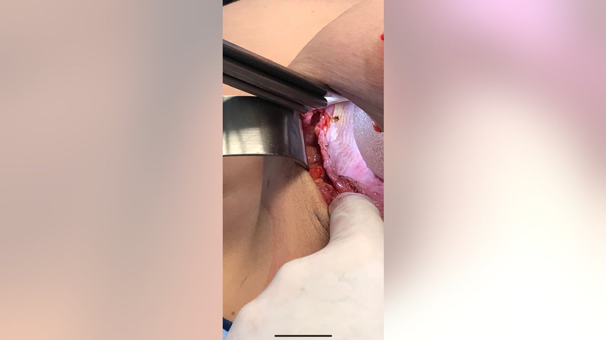 Textured implant in place