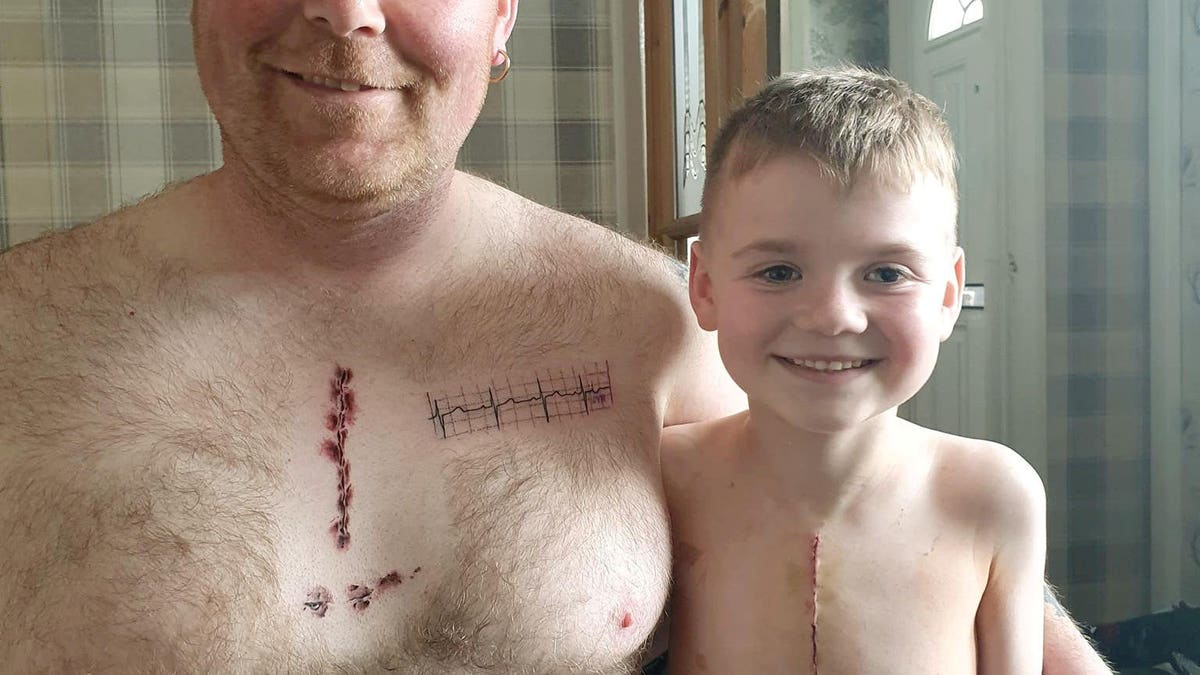 Dad Tattoos His Son's Cancer Scar On His Own Head