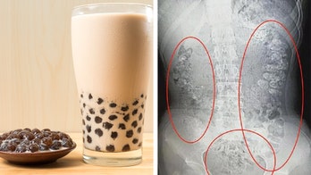Doctor discovers 100 bubble tea pearls in girl’s abdomen during CT scan: report