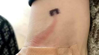 Mom shares photo of son's infection to warn others about sepsis