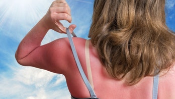 'Sunburn tattoos' are a painful way to show off your style