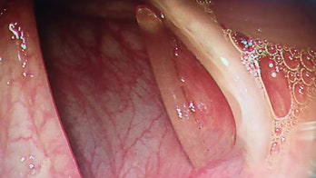 Doctors pull foot-long parasitic worm from woman's intestines