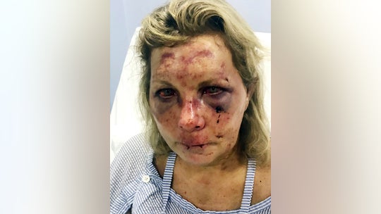 US tourist beaten during Dominican vacation accuses resort of victim blaming