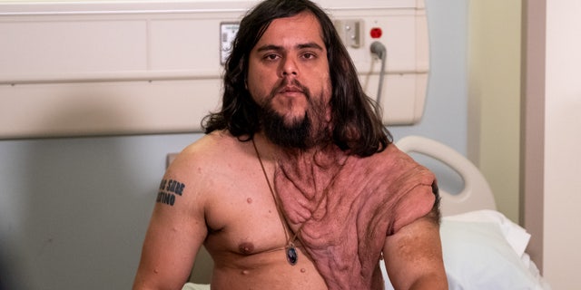 Galvan, pictured before his surgery, started developing symptoms when he was just 5, which led to a childhood marred by bullying.