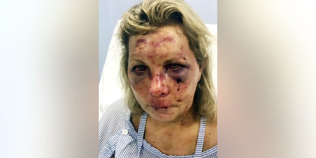 This undated photo made available by Chris Daley shows his wife, Tammy Lawrence-Daley, after an alleged attack at a resort in the Dominican Republic in January. (Chris Daley via AP)