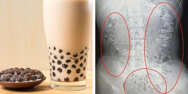 A doctor in China thinks that an excessive amount of bubble tea beads has caused stomach problems to the girl.
