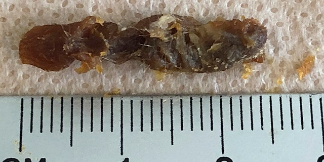He had estimated it to be 3-centimeters long, which would have taken up the patient's entire ear canal, but it was .5-centimeters shy of that measurement. 