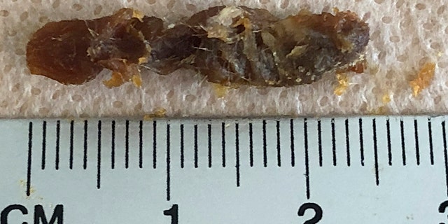 He had estimated it to be 3-centimeters long, which would have taken up the patient's entire ear canal, but it was .5-centimeters shy of that measurement.