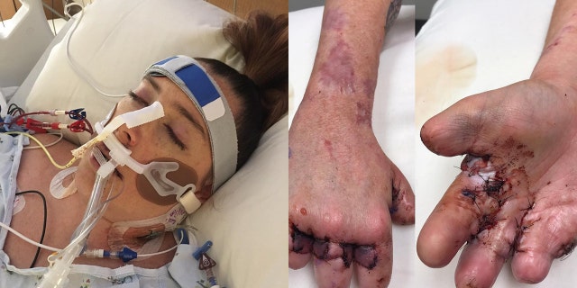 Acuff's health issues didn't end with her release from the hospital in August, as she underwent her most recent amputation just two weeks ago.