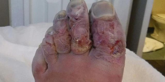 Griffith's toes were removed upon further treatment in England.