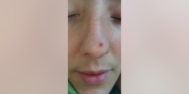 Laure Seguy's cancer began as a small spot on the end of her nose that refused to go away .