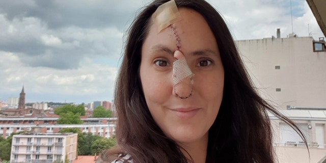 Seguy, pictured seven days after her second surgery which grafted skin from her forehead to her nose.