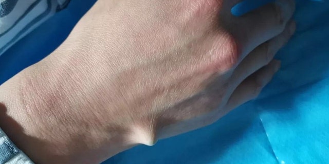 The chopstick went through the man's palm and nearly through the other side.