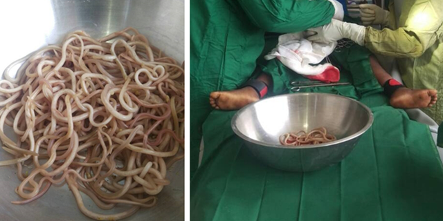 The boy's case was published in the Journal of Medical Case Reports on May 24, where surgeons noted an intestinal blockage caused by a worm infestation.
