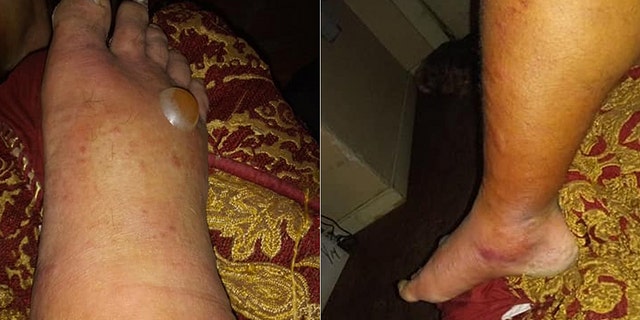 He's undergone at least four surgeries to remove affected tissue.