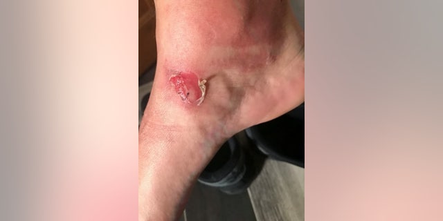 Thomas was left "screaming" and suffered horrendous burns and blistering to his ankles.