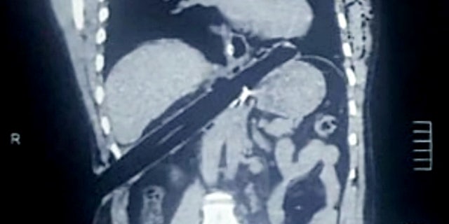 An X-ray shows the bamboo's trajectory after it pierced his skin and traveled upward through his chest.