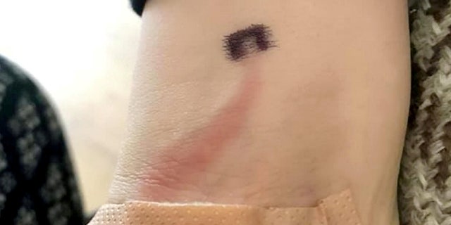 Ewan Ruddy's right arm with red mark on wrist - the black mark is what the doctor marked to make sure the red line doesn't get any bigger.