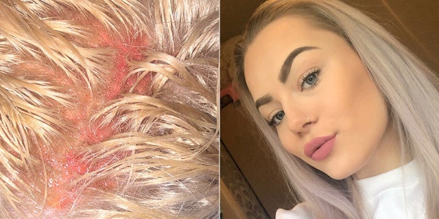 Schofield's claims have been refuted by the hairdresser, who has not been identified but said the reaction could have happened with any hairdresser.