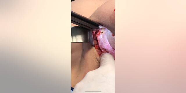 Textured implant in place