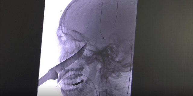 Jimmy Russell said she still isn't sure what happened, but she heard her son screaming before he showed up at the door with a knife sticking out of his face.
