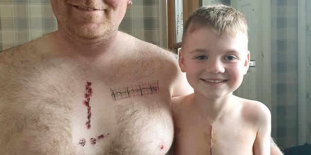 Martin Watts got inked with the tattoo to match his son Joey, who underwent a life-saving open heart surgery at Leeds Children's Hospital four weeks ago.