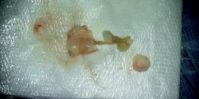 The larval tapeworm looked like a "quail's egg," doctors said.