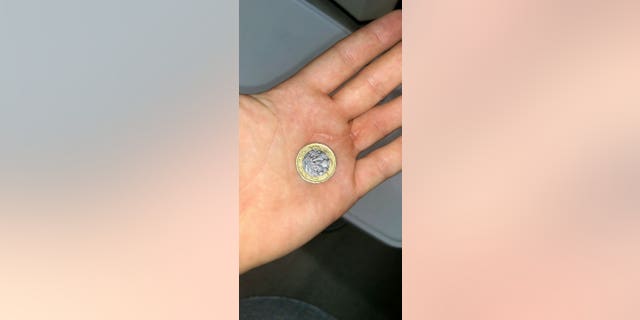 Surgeons removed the coin and he said he missed several days of work.