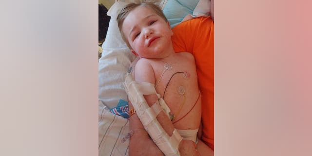 The toddler developed a rash after being bitten by a tick infected with RMSF, said his mother. (Kayla Oblisk)