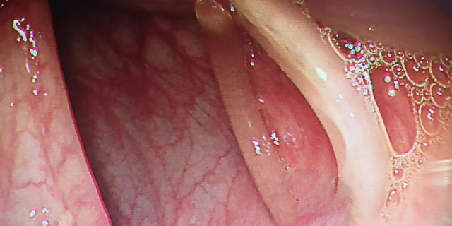 She had been suffering from abdominal pains on and off for the last decade.